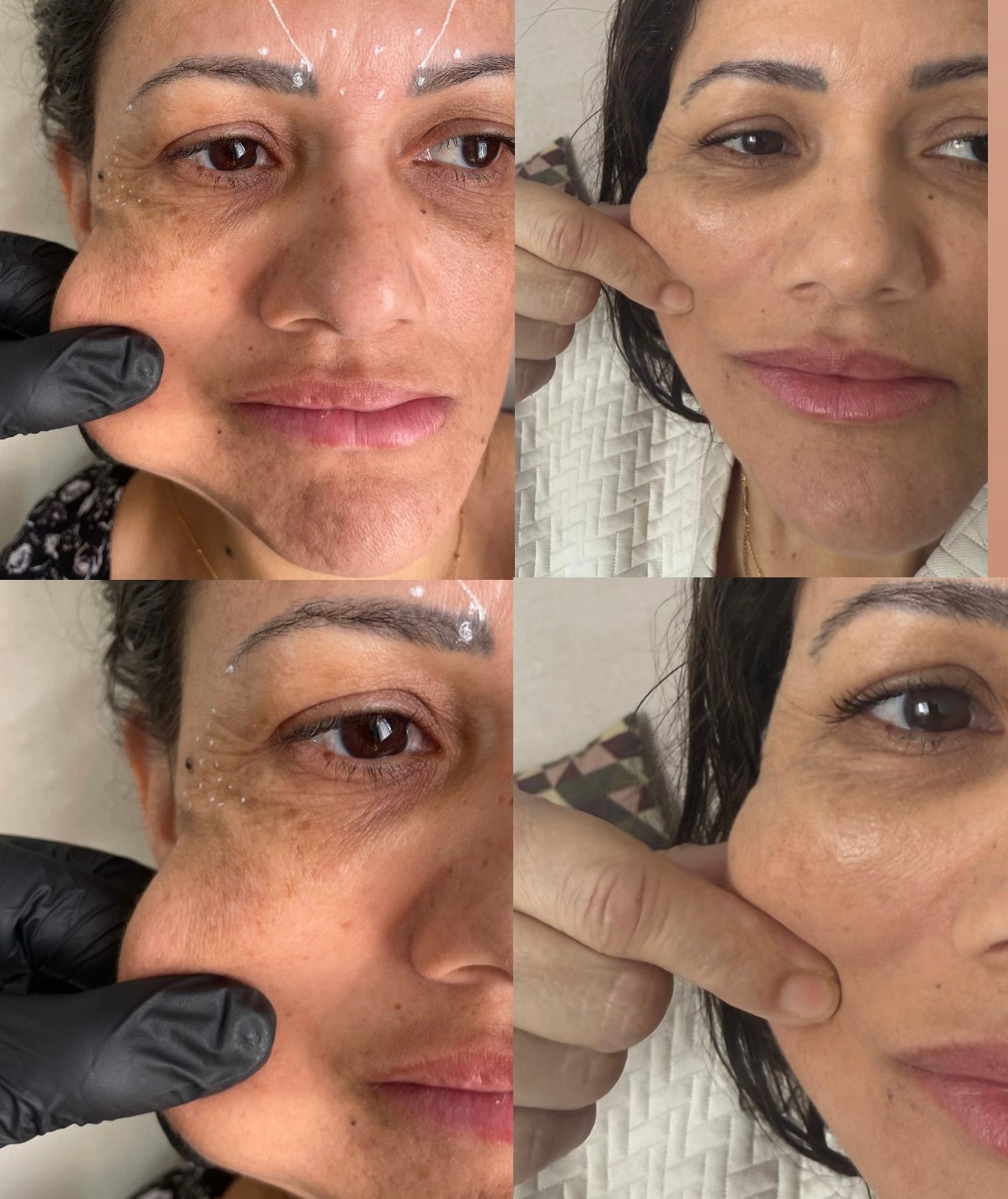 Antes e depois de tratamento facial