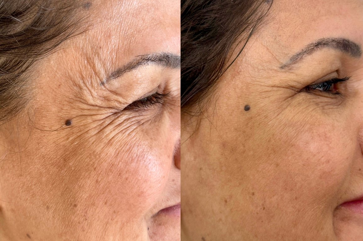 Resultado de tratamento facial